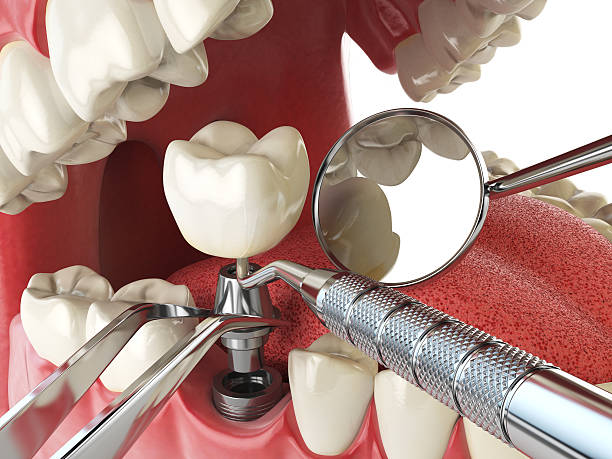 Best Emergency Tooth Extraction in Madison Heights, VA